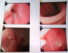 学法后拍片，胃结石消失