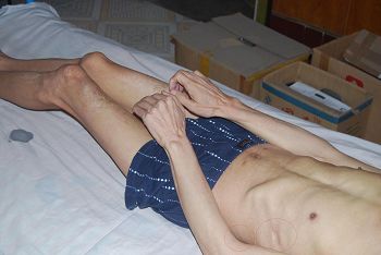 '肋部被鞋刷子捣烂感染，全身肌肉萎缩体重不足90斤'