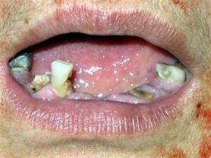 '酷刑工具:开口器