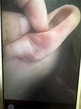 '刘兵欢受迫害后的伤'